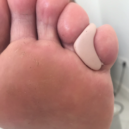 Separador dedos jerez podologo. Valoracion con plantillas pisada. Ortopodología en Jerez.