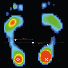 Imagen de la pisada jerez de la frontera podología