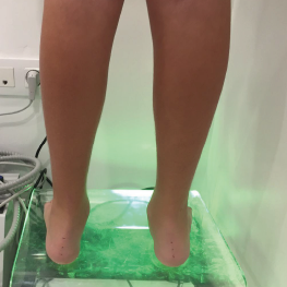 Plataforma de la pisada Podología en podología pediátrica en jerez