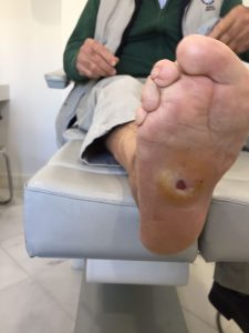 Evolución pie diabético Jerez España