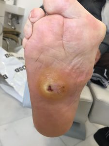 Evolución pie diabético Jerez España