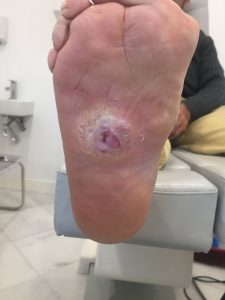 Evolución pie diabético Jerez España