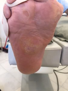 Evolución pie diabético Jerez España