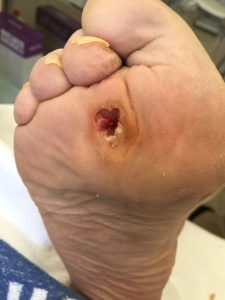 Pie diabético en Jerez