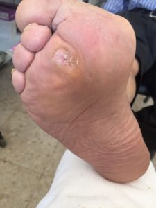 Pie diabético en Jerez